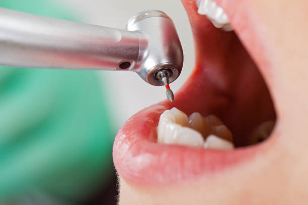 Best Emergency Tooth Extraction in Catlin, IL
